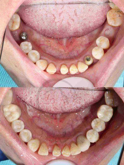 重庆贵金属烤瓷牙费用多少钱——重庆齿齿美口腔