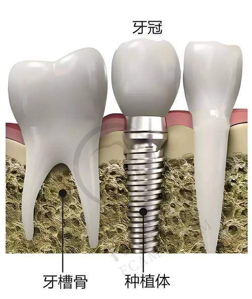 重庆贵金属烤瓷牙费用多少钱——重庆巴南众植博士口腔