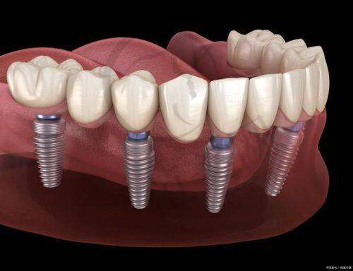 无锡德国费亚丹Frialit种植体价格一览表:4599元单颗与85000元全口价格解读