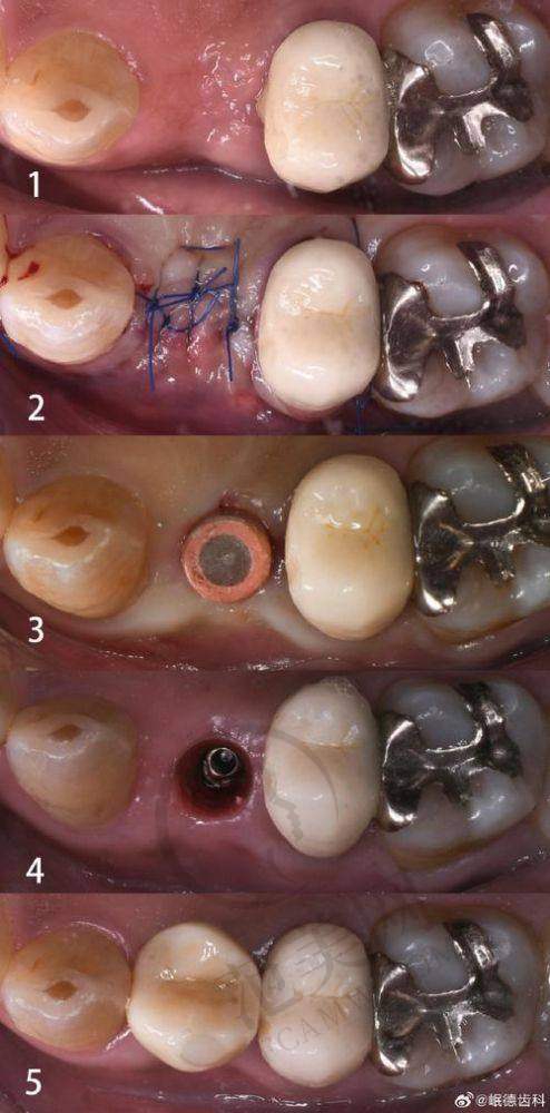 重庆贵金属烤瓷牙费用多少钱?2025年1000-2500起/颗,钯银钯金材质区分+爱牙世家2500起