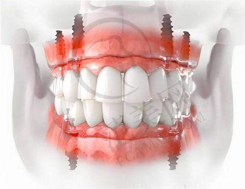 重庆附近哪家做瑞士士卓曼Straumann医院好——重庆医 科 大学附属口腔医院