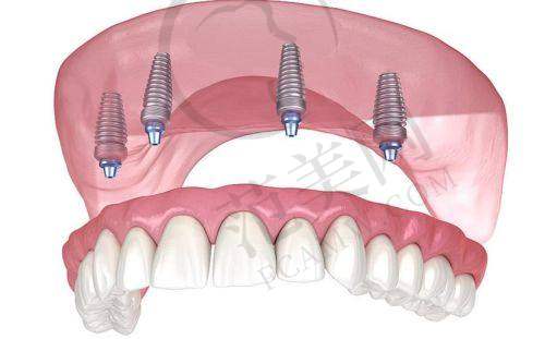 重庆附近哪家做瑞士士卓曼Straumann医院好——重庆名博士口腔医院