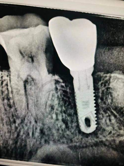 2025年重庆义齿医院排名——重庆团圆口腔