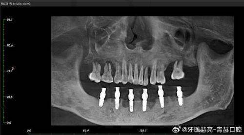 2025年重庆义齿医院排名——重庆美奥口腔