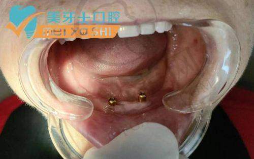 2025年重庆义齿医院排名——重庆鹏博口腔