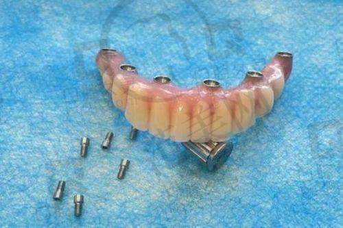 重庆西班牙MG种植牙——重庆团圆口腔医院