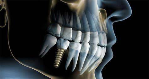 重庆西班牙MG种植牙——重庆万州圣悦口腔门诊部