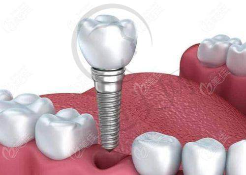 重庆附近哪家做瑞士士卓曼Straumann医院好——重庆好未来牙科