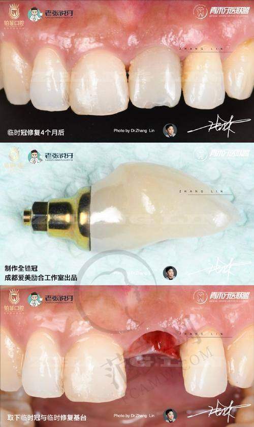 重庆附近哪家做瑞士士卓曼Straumann医院好——重庆渝北区亿佰口腔