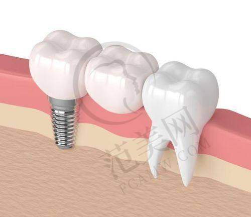 重庆益佳口腔诊所——3D植入技术的韩国美格真种植牙