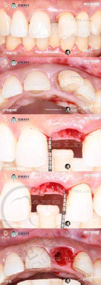 重庆附近哪家做瑞士士卓曼Straumann医院好——重庆乐乐欣口腔