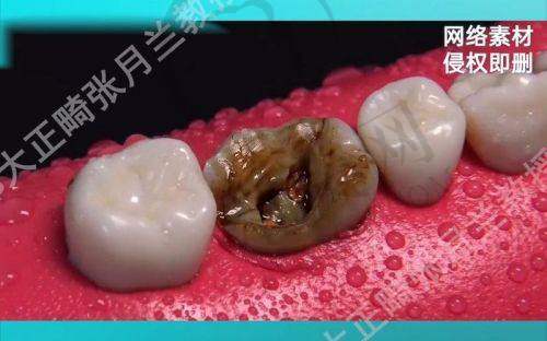 重庆西班牙MG哪家便宜又好?团圆/成佳牙博士等医院单颗2680元起