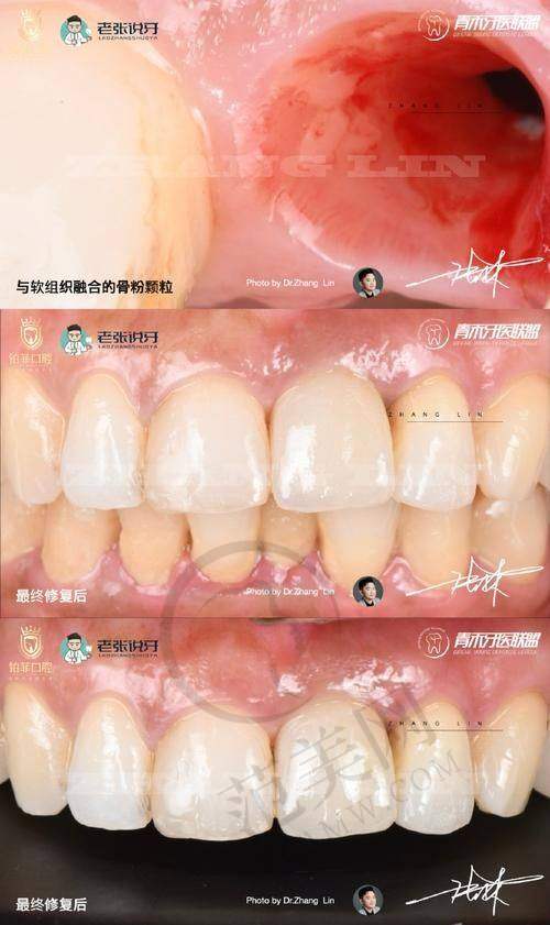 重庆做多生牙（双排牙）哪个医生好——重庆沙坪坝爱牙口腔门诊部