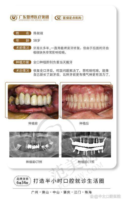 重庆做多生牙（双排牙）哪个医生好——重庆大学附属涪陵医院口腔分院