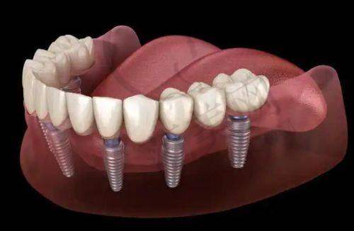 重庆附近哪家做瑞士士卓曼Straumann医院好——重庆八益口腔