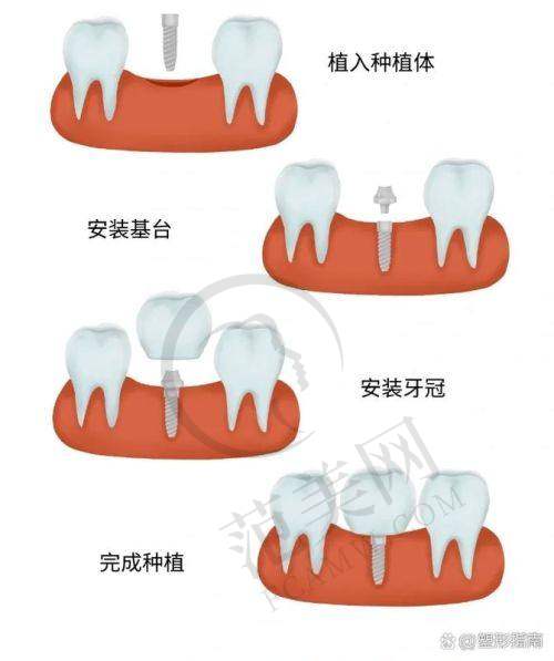 重庆垫江陈绍春口腔——高品质韩国美格真种植牙服务