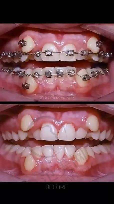 重庆开州德贝口腔——数字化导航植入的韩国美格真种植牙