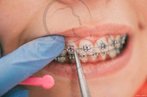 唐山儿童早期矫治医院价格表影响因素