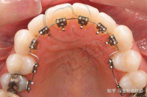 重庆儿童磨牙症哪家医院好——重庆美奥口腔医院