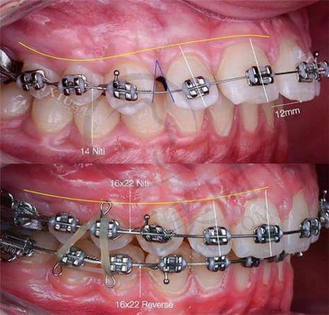 重庆隐形托槽矫正和青少年牙齿矫正哪家医院好——东莞口腔医院