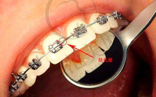 重庆隐形托槽矫正和青少年牙齿矫正哪个技术好?德亚口腔:传统5000起/隐形1.68万起