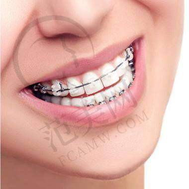 重庆咬合矫正贵吗——重庆牙博士口腔医院