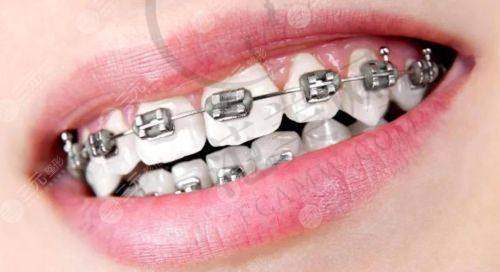 重庆隐形托槽矫正和青少年牙齿矫正哪家医院好——武汉第一口腔医院