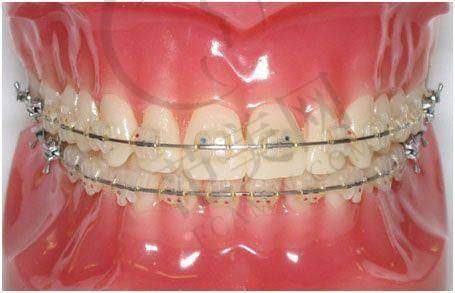 重庆隐形托槽矫正和青少年牙齿矫正哪家医院好——肇庆市第一人民医院
