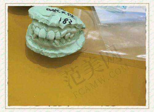 重庆隐形托槽矫正和青少年牙齿矫正哪家医院好——青岛可恩口腔医院