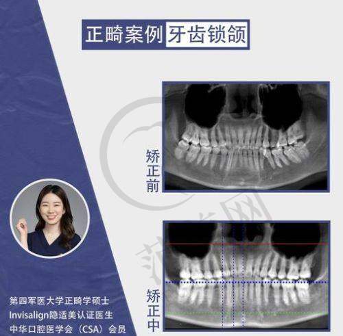 重庆咬合矫正贵吗——重庆松山医院