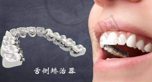 重庆舌侧隐形矫正哪个医院做得好?好未来沈渝丁医生+牙卫士等医院案例价格解析