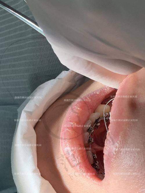 重庆舌侧隐形矫正哪个医院做得好——合川中附大口腔