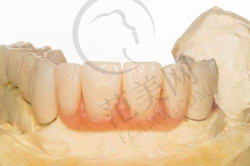重庆贵金属烤瓷牙费用多少钱——重庆医科大学附属第一医院口腔颌面外科