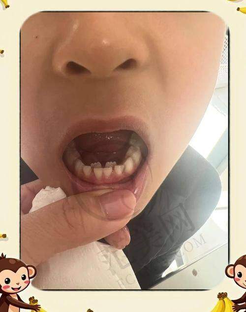 重庆做多生牙（双排牙）哪个医生好——重庆协尔口腔门诊部