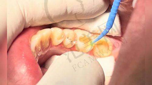 重庆儿童磨牙症哪家医院好：重医附属儿童医院46位医生|美奥口腔杜鹏擅长儿童MRC矫正