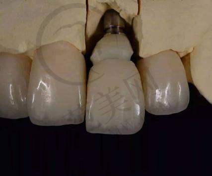 重庆美容冠美白手术价格一览表：2024 - 2025年高低价位解析及优质医院推荐 