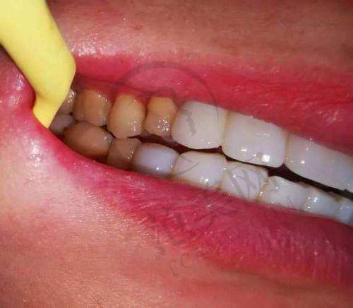 重庆美容冠美白手术价格一览表之顾客好评情况