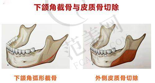 杭州做下巴吸脂术医院排行榜——杭州市第一人民医院医疗美容科