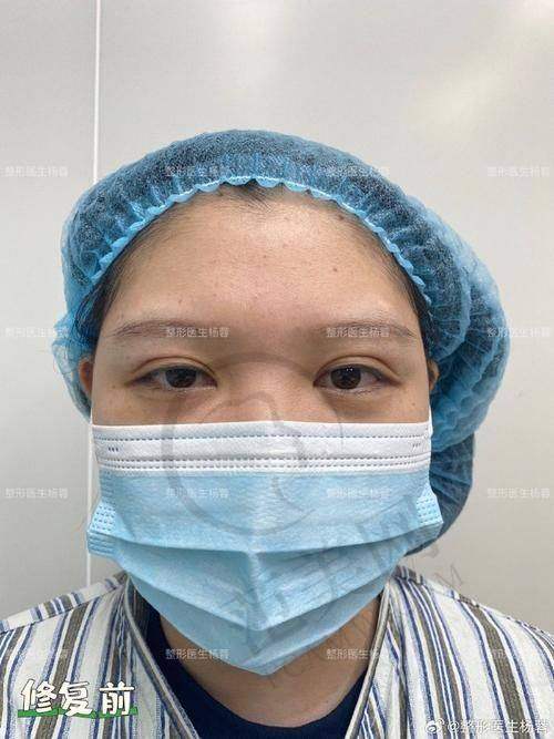 杭州半恒久睫毛线医生排行榜——杭州时光整形医院