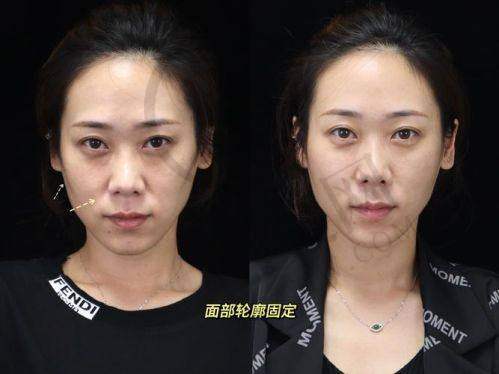 杭州做轮廓三件套更出名的三家医院——杭州维多利亚医疗美容医院有限公司