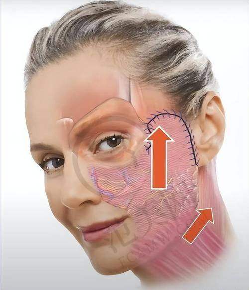 杭州拉皮手术提升官网认证医生——杭州薇琳医疗美容医院