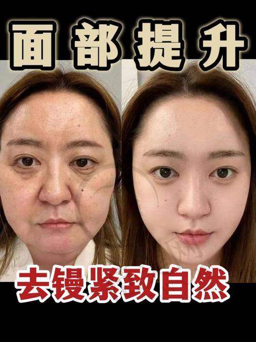 杭州拉皮手术提升官网认证医生——杭州米兰柏羽医疗美容医院