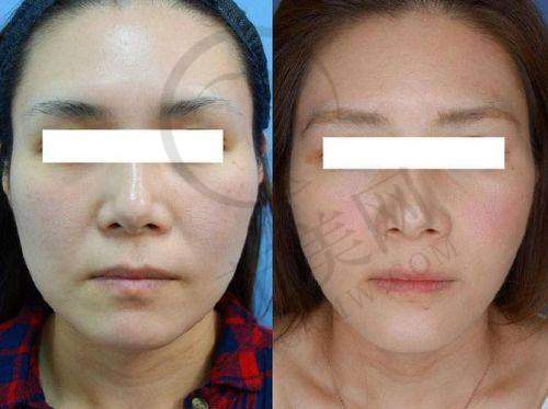 杭州拉皮手术提升官网认证医生——杭州维多利亚医疗美容医院