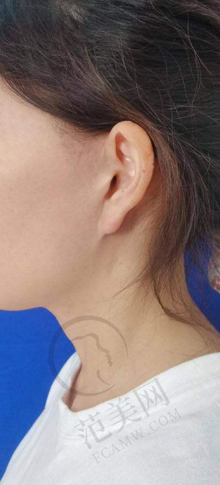 杭州拉皮手术提升官网认证医生——杭州第一人民医院