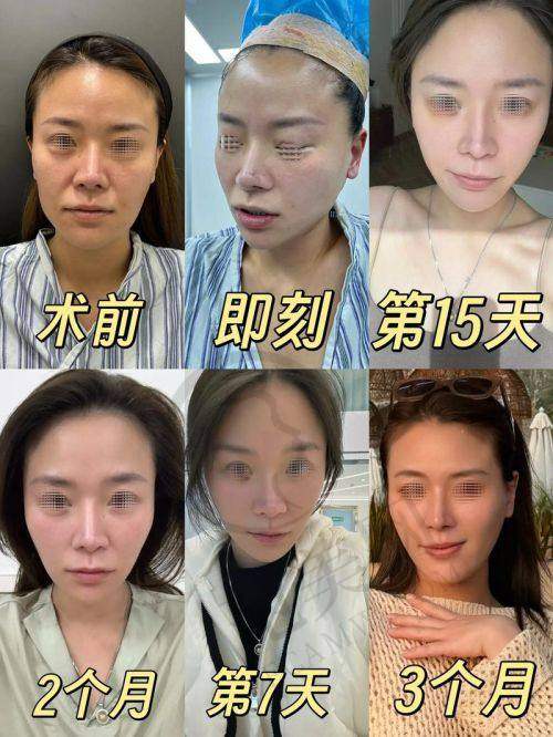 杭州拉皮手术提升官网认证医生——省人民医院