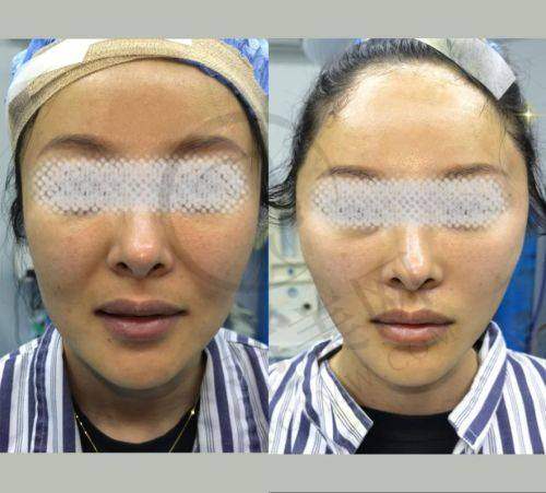 杭州拉皮手术提升官网认证医生:彭涛/陈文才微创小切口技术受求美者青睐