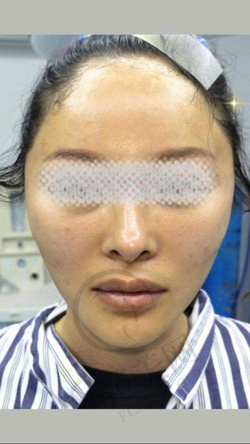 杭州拉皮手术提升官网认证医生——杭州连天美医疗美容医院