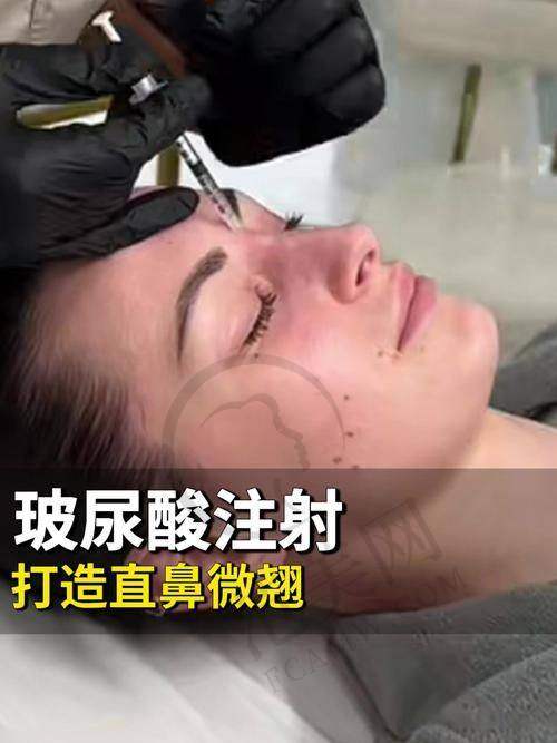 杭州注射祛法令纹性价比排名——杭州奥拉克