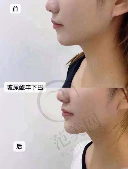 杭州注射祛法令纹性价比排名——杭州时光