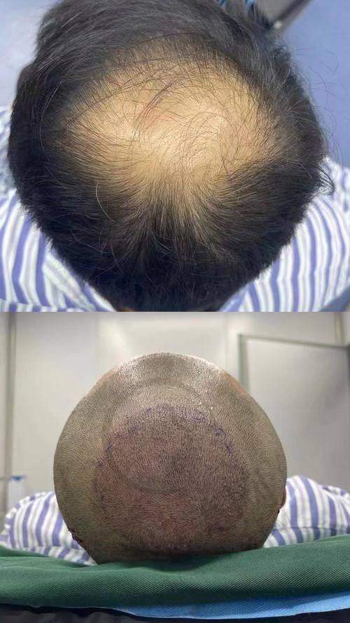 杭州胡须种植哪个医生好——杭州首瑞植发